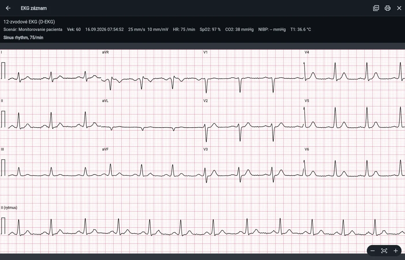 12-lead ECG paper printout — zoom, PDF download and print.